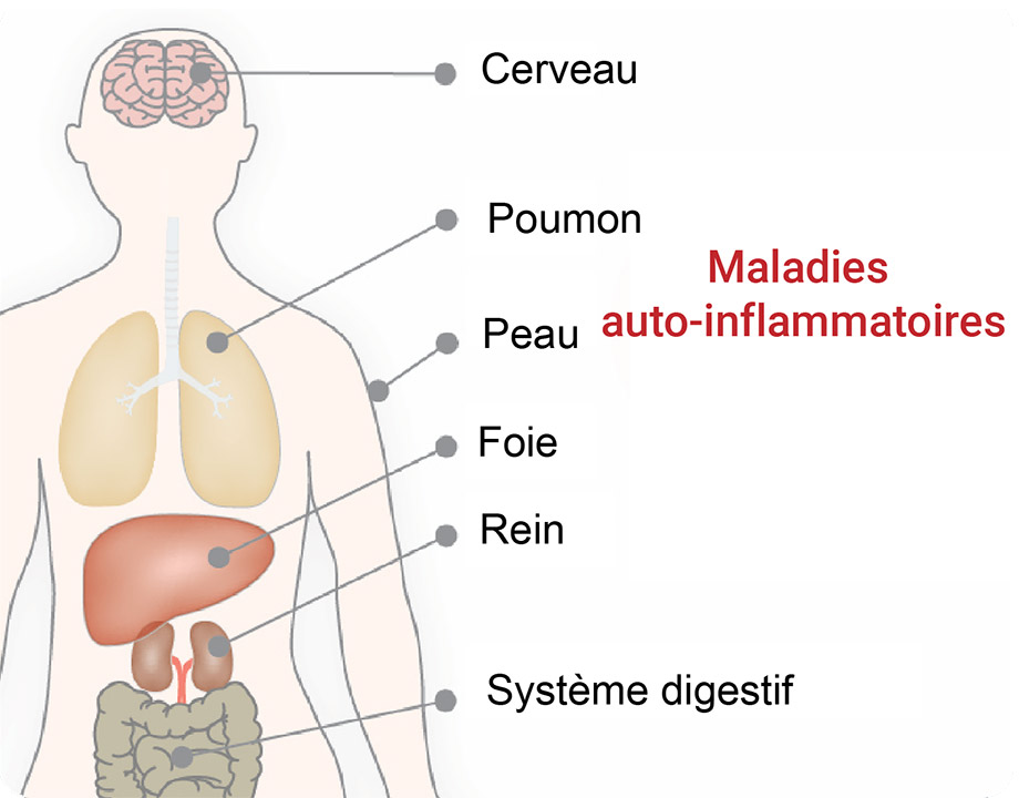 Auto Inflammatory Disease - diagram